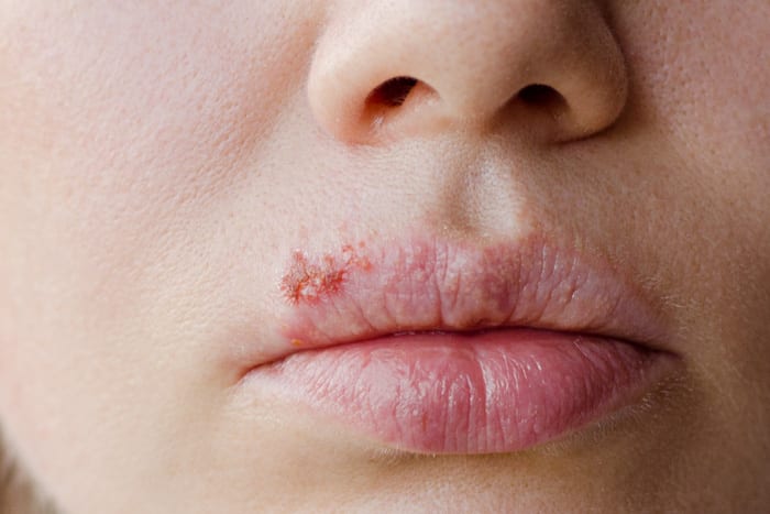 stages-of-oral-herpes-livestrong-com